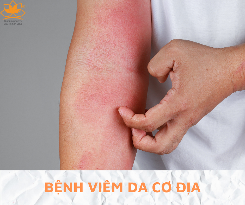 BỆNH VIÊM DA CƠ ĐỊA